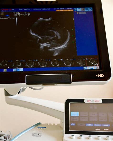 ecografia transfontanelara|The ABCs of transfontanellar ultrasound and more